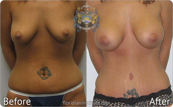 ba-gallery bodytummy2-1