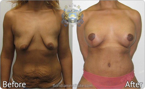 ba-gallery breastlift1-1