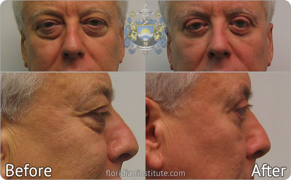 ba-gallery faceeyelid1