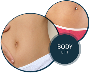 Body Lift