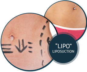 Liposuction
