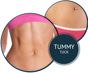 Tummy Tuck