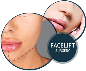 Facelift Surgery