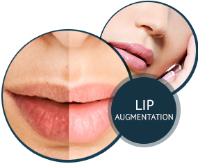 Lip Augmentation
