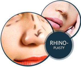 Rhinoplasty