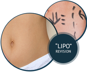 Liposuction Revision