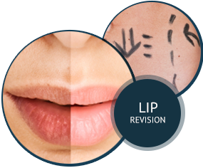 Silicone Lip Revision